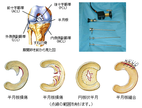 関節鏡視下手術｜整形外来｜医療法人 悠康会 函館整形外科クリニック
