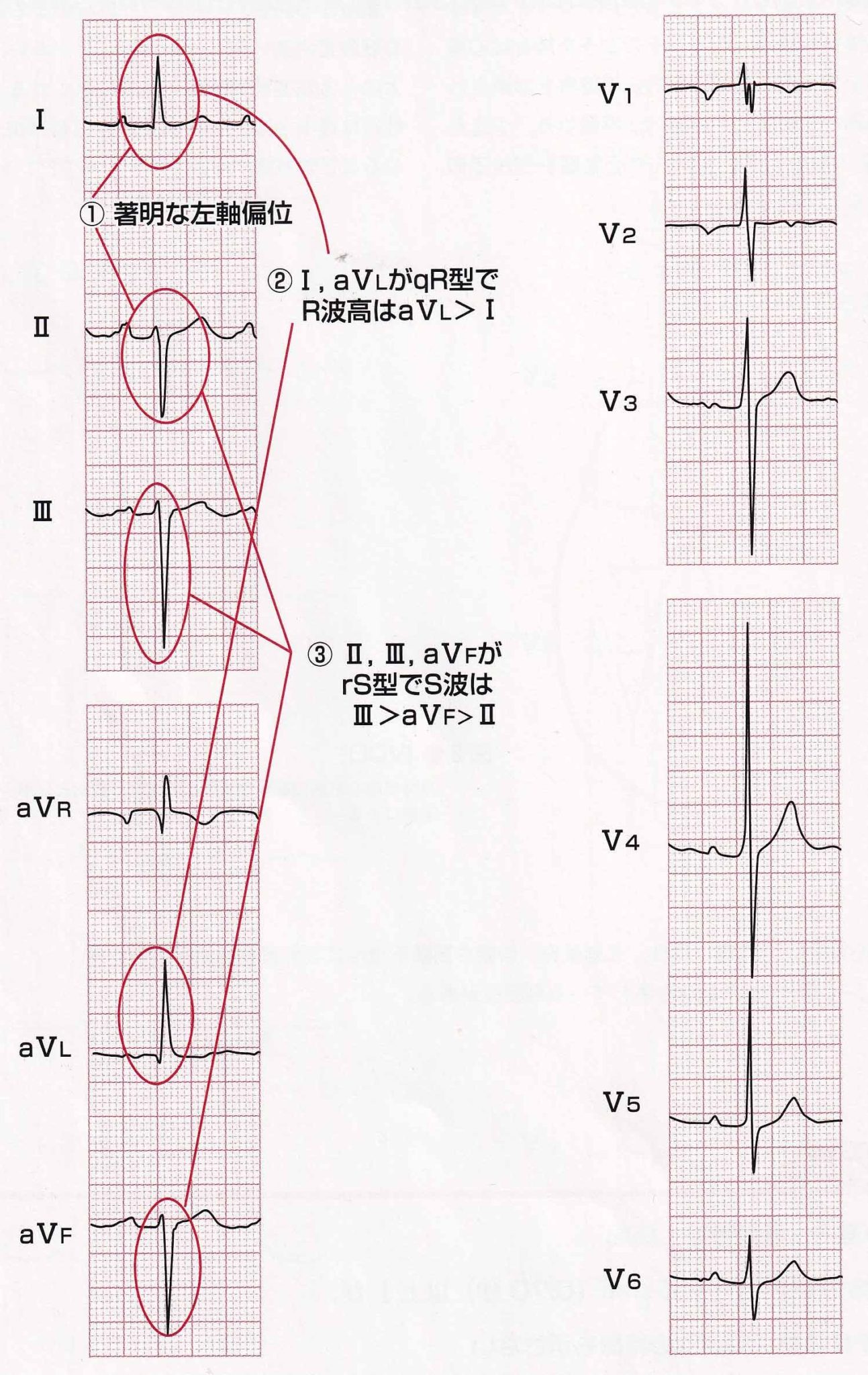 心電図所見 – Welcome to 佐野内科ハートクリニック
