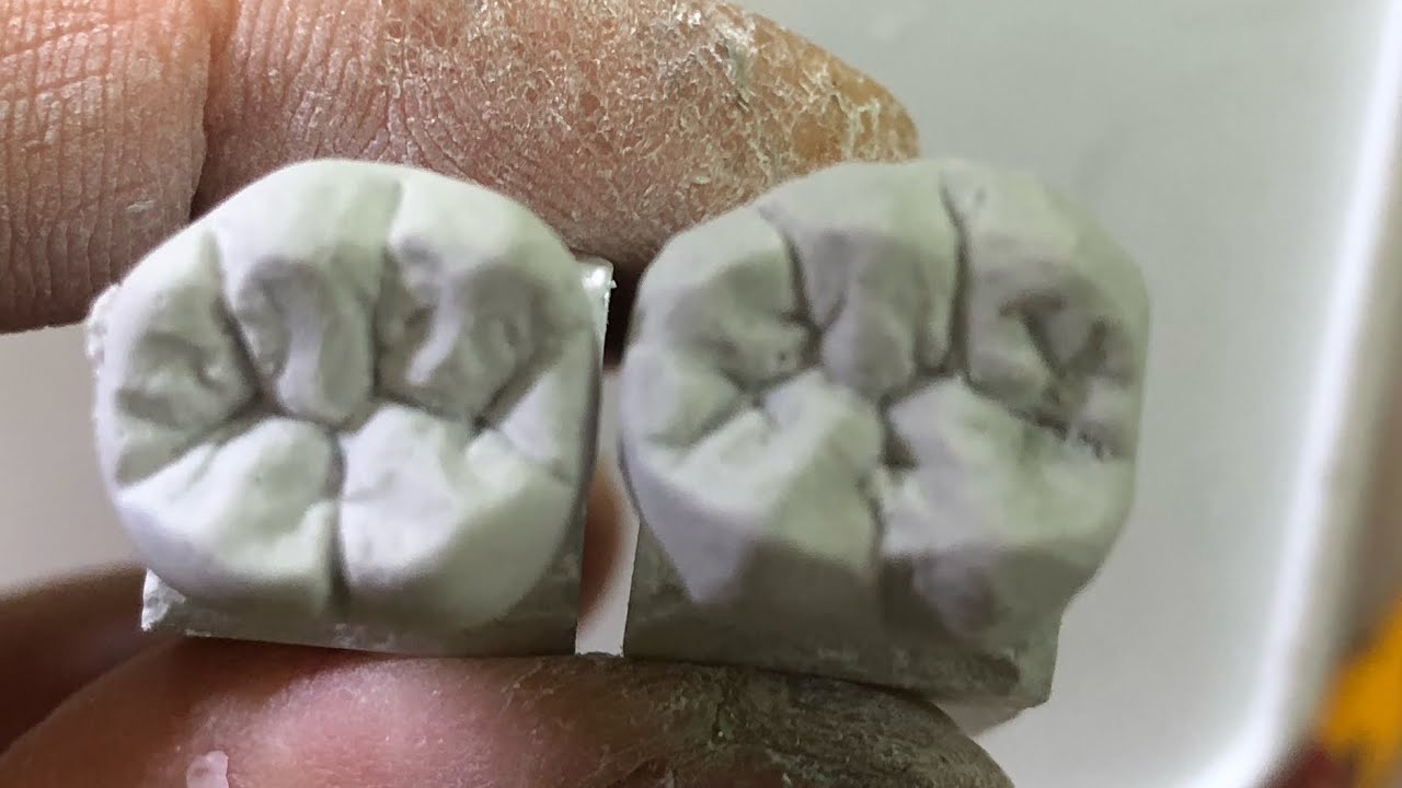🔰下顎6 歯型彫刻 - YouTube