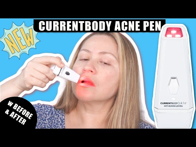 CURRENTBODY SKIN ANTI-ACNE LED PEN | How to get rid of acne