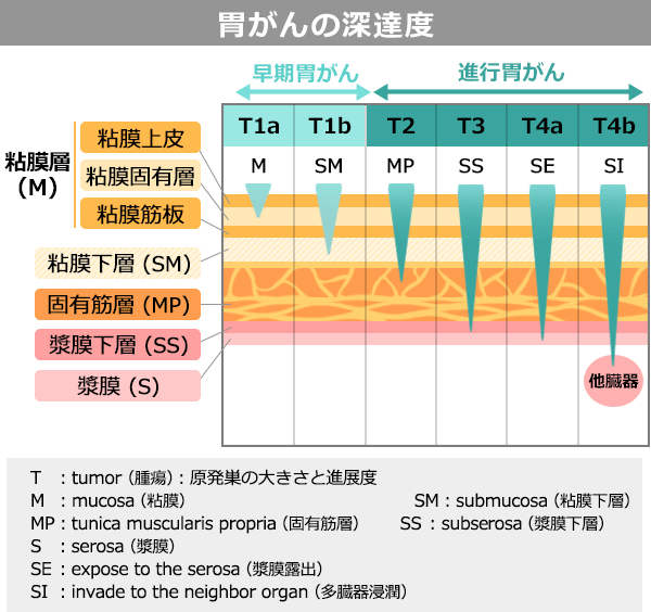 いまさら聞けない「ステージ」と「スキルス」の意味｜けいゆう先生の
