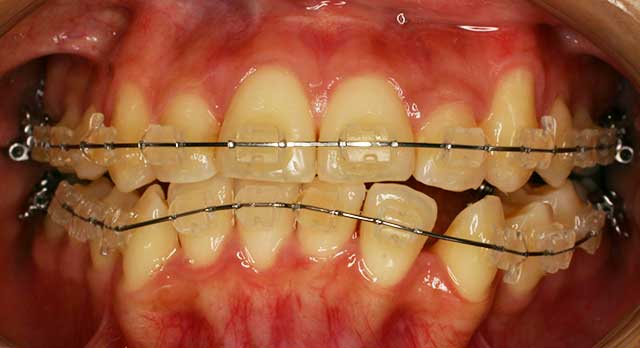 非抜歯矯正でよく使う装置｜矯正・自由が丘歯科室