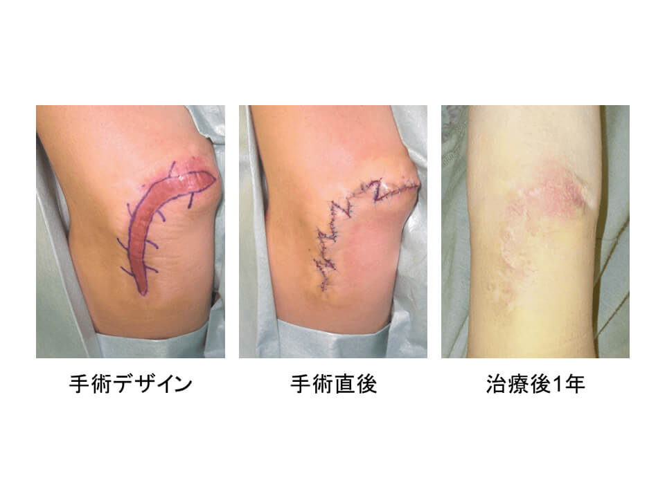 瘢痕拘縮｜日本形成外科学会