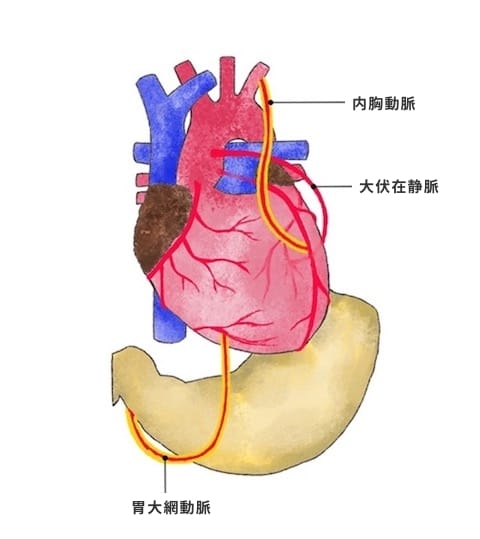 冠動脈バイパス術（CABG)｜順天堂医院 心臓血管外科