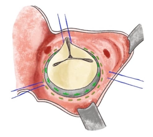 弁膜症｜順天堂医院 心臓血管外科