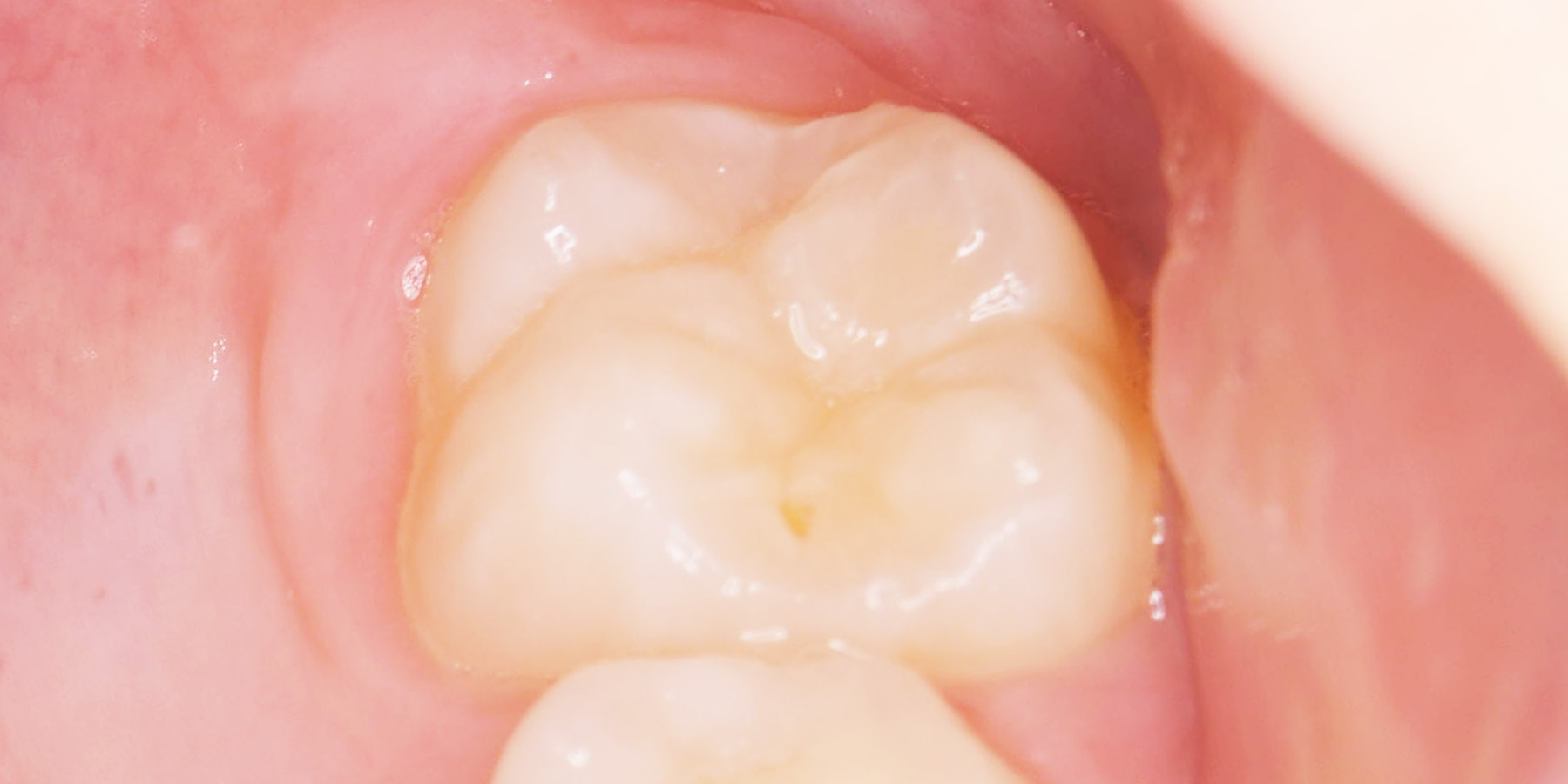 たいせつなろくちゃん（第一大臼歯・六歳臼歯）｜きづがわ矯正歯科 村