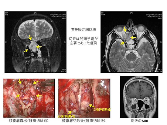 経鼻内視鏡頭蓋底手術（改訂） | KOMPAS – 慶應義塾大学病院 医療