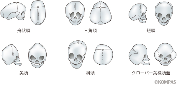 頭蓋縫合早期癒合症 | KOMPAS – 慶應義塾大学病院 医療・健康情報サイト