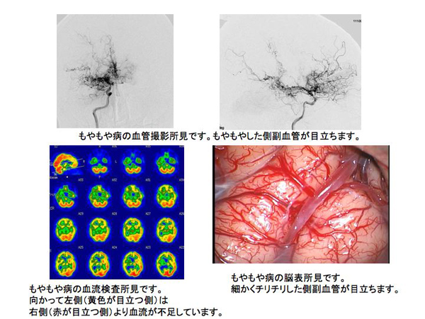もやもや病 | KOMPAS – 慶應義塾大学病院 医療・健康情報サイト