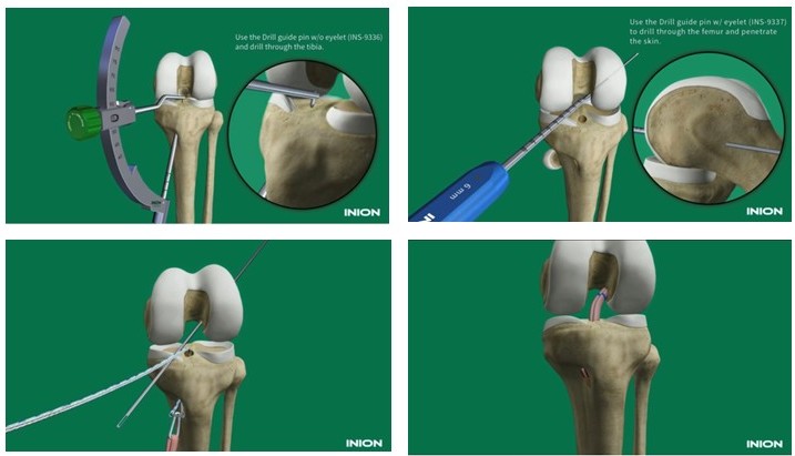 Hybrid前十字靭帯再建術】翌日退院｜横浜整形外科｜関節鏡手術