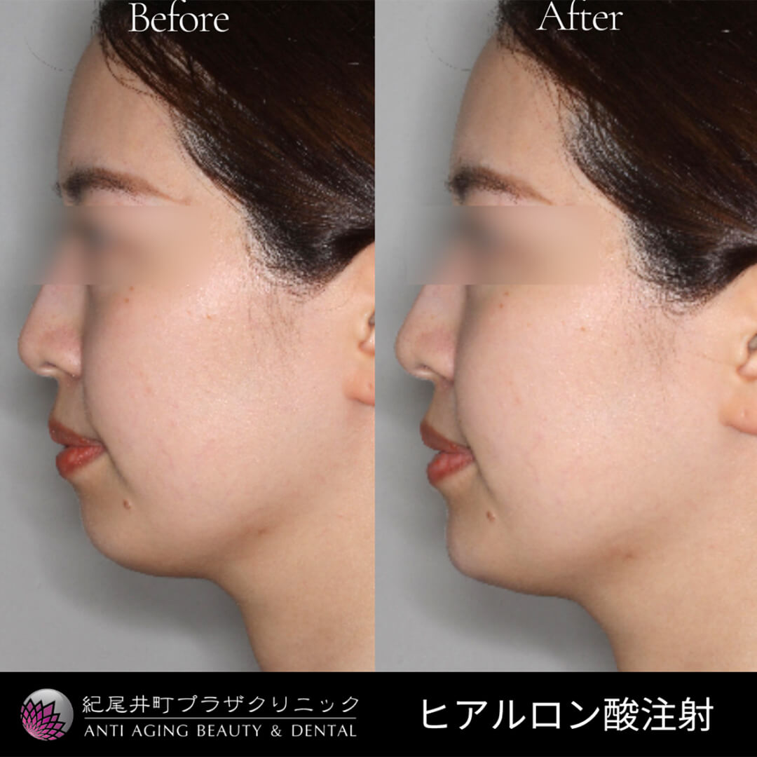 東京千代田区でヒアルロン酸注射なら紀尾井町プラザクリニック
