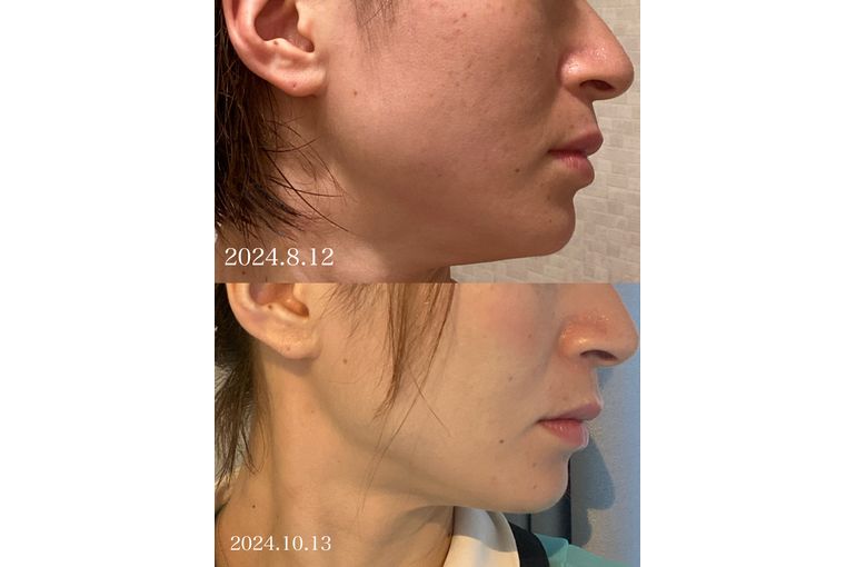 リアボーテ 大阪】ディゾセラム 2か月の効果