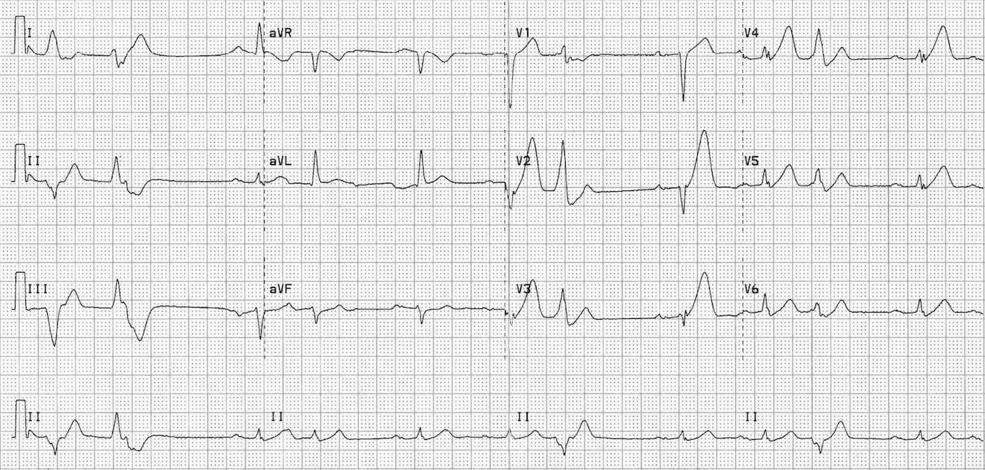 Anterior Myocardial Infarction • LITFL • ECG Library Diagnosis