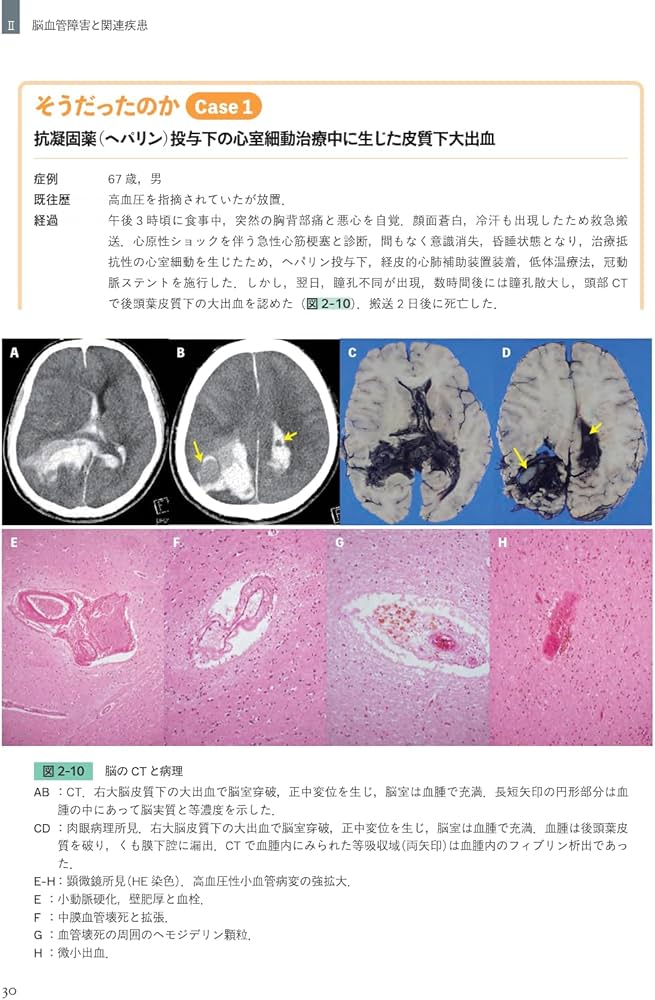 同一症例の経過・画像・病理で紐解く 臨床神経病理ワールド | 宇高不可