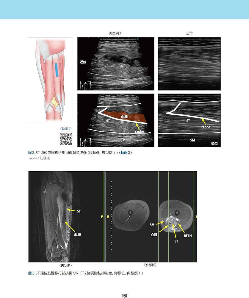 スポーツ障害〉筋損傷のエコー活用術 ―電子版付― | 和田 誠, 熊井 司