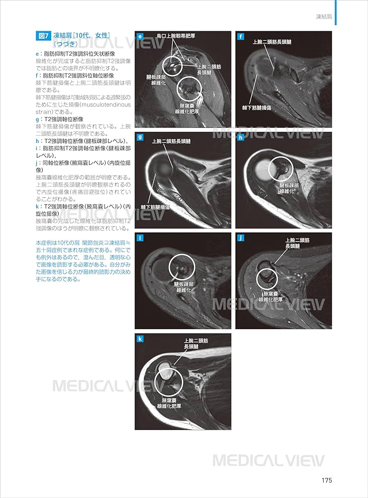 肩関節のMRI−読影ポイントと新しい知見−第3版 | 佐志 隆士, 秋田
