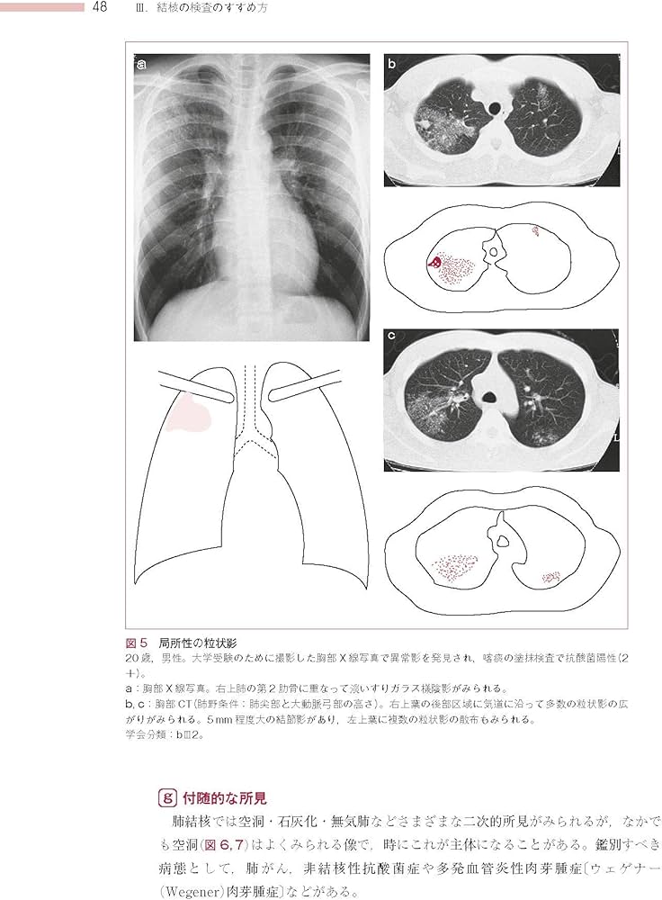 医療者のための結核の知識 第5版 | 四元 秀毅 |本 | 通販 | Amazon