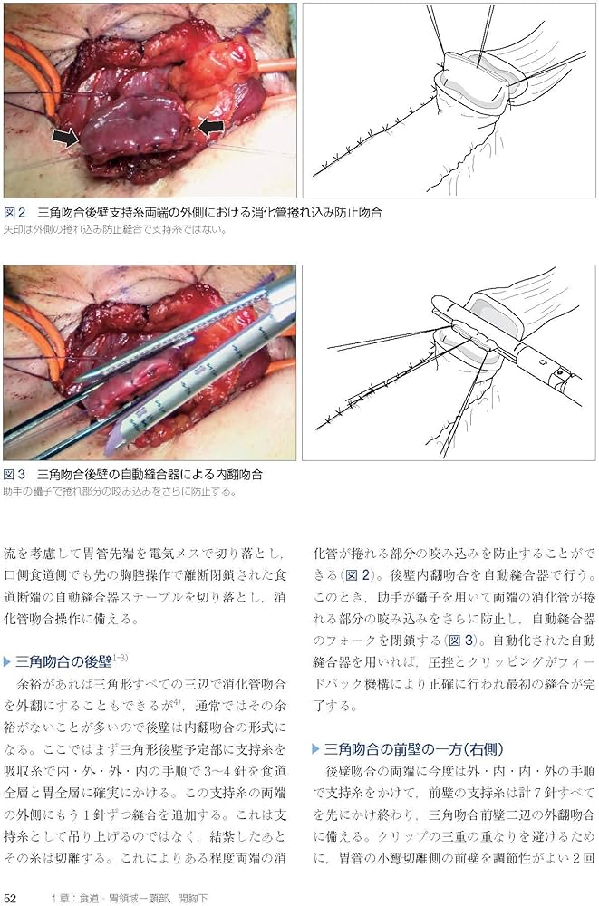 消化管吻合法バイブル [Web動画付] | 北島 政樹 |本 | 通販 | Amazon