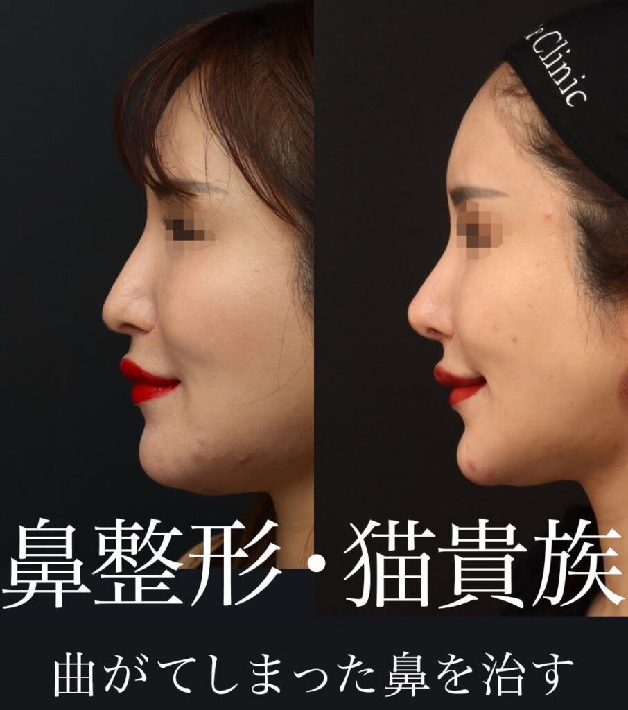 曲がって息ができなくなった鼻の治療【鼻中隔延長、斜鼻修正、猫貴族