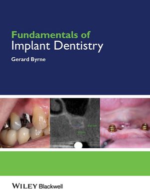 Fundamentals of Implant Dentistry | Wiley