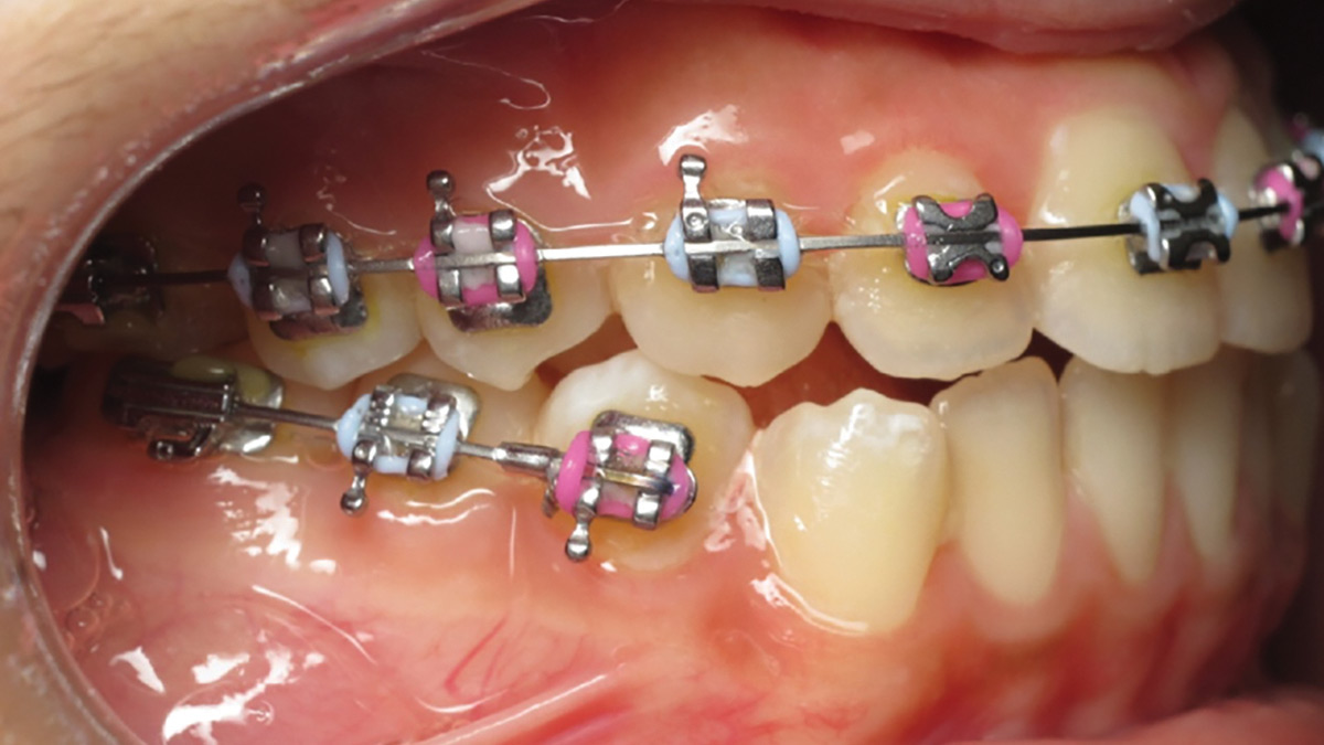 Non-Surgical Compensation Of Skeletal Class III Malocclusions
