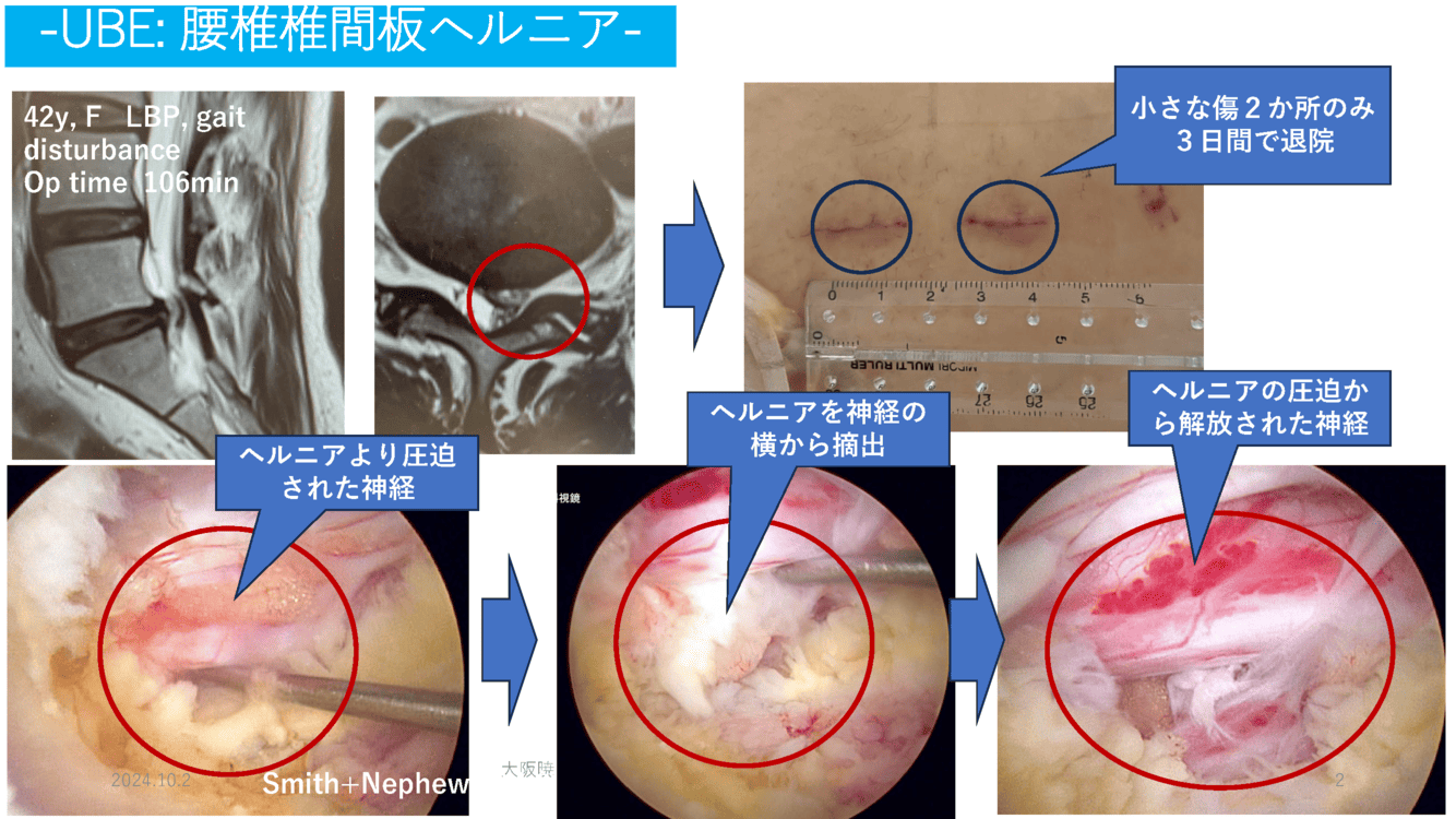 腰椎椎間板ヘルニアや脊柱管狭窄症を治療する新しい脊椎内視鏡手術手技