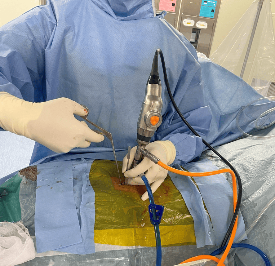 腰椎椎間板ヘルニアや脊柱管狭窄症を治療する新しい脊椎内視鏡手術手技