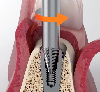 MegGyver Kit｜製品情報｜株式会社メガジェンジャパン｜歯科用