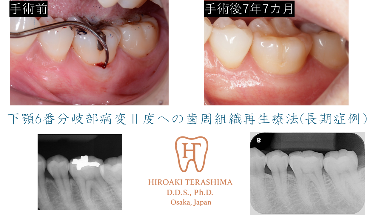 Ⅱ度分岐部病変に対する再生療法で長期安定を得た症例（左下6番・7年7
