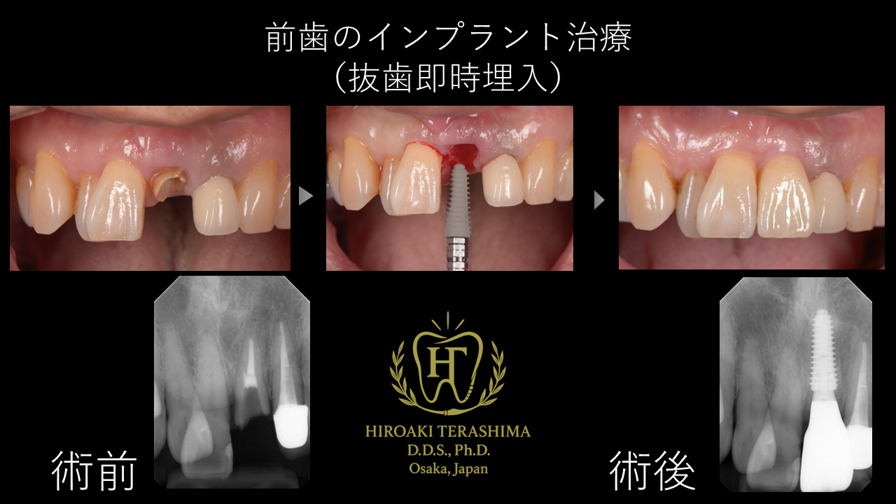 前歯が折れた場合の治療法｜抜歯即時インプラントによる審美回復症例