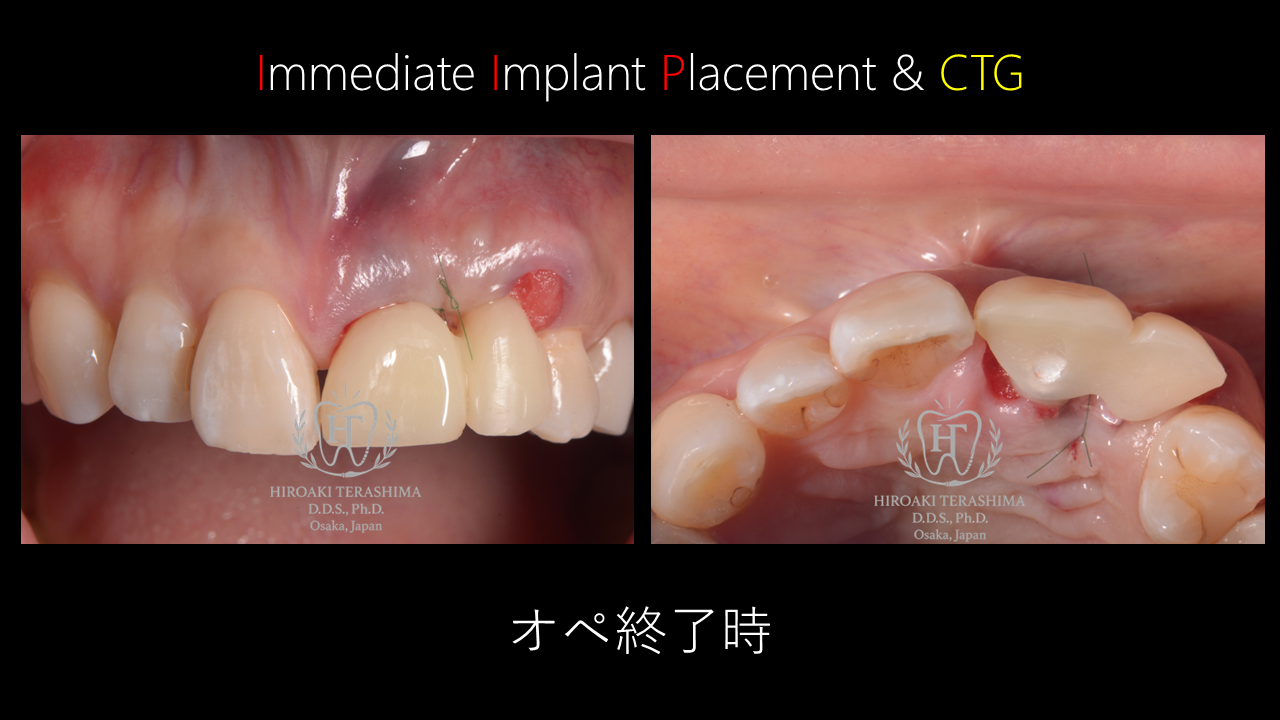 前歯のインプラント〜重度の歯列不正に対するシミュレーション主導の