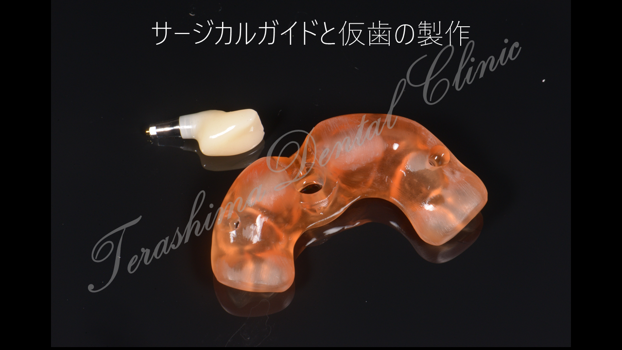 前歯のインプラント治療~やっぱり前歯部は難しい～ | 箕面市の歯医者