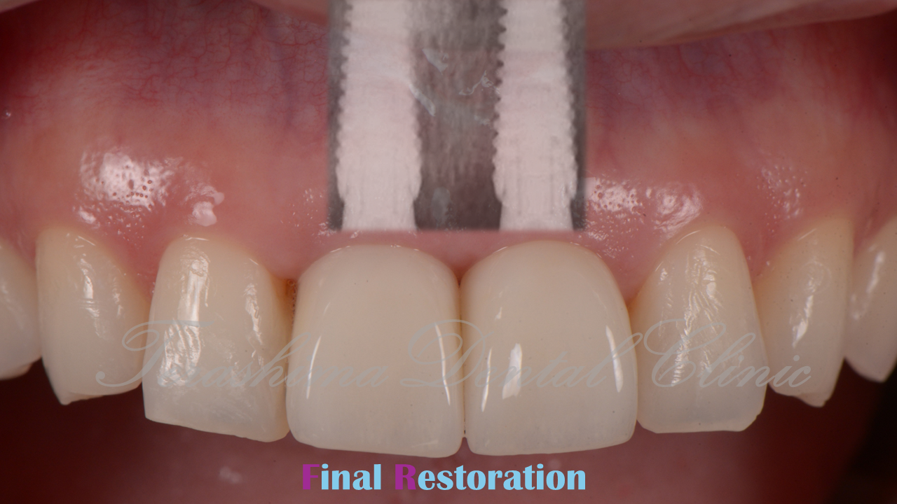 前歯のインプラント～ルートメンブレンテクニック～ | 箕面市の歯医者