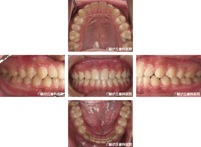 矯正治療」症例集 - 江南市の歯医者 緑が丘歯科医院 歯周病・矯正