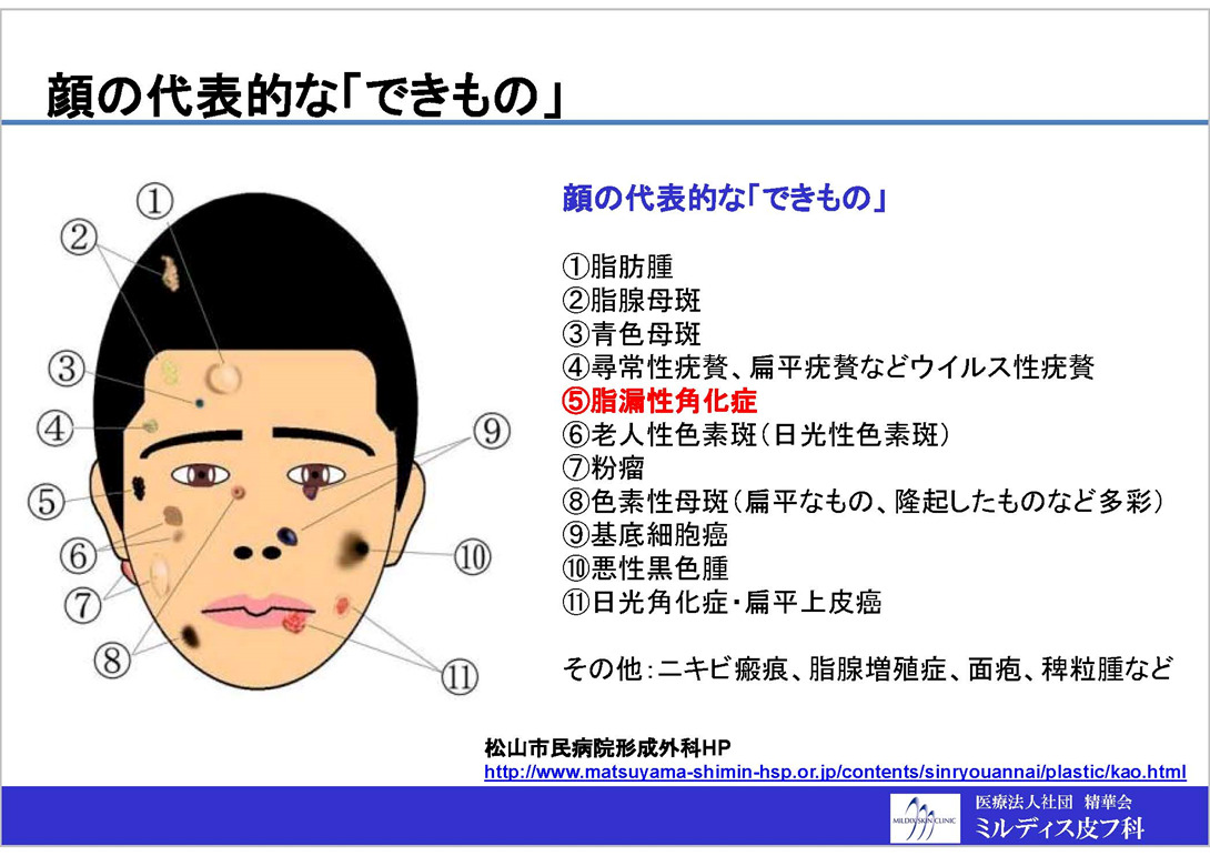 多発イボの炭酸ガスレーザーによる治療（顔） - ミルディス皮フ科 北千住院