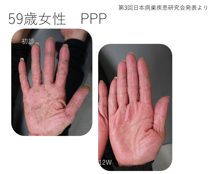 医師解説】掌蹠膿疱症の治療を通して考える「ら」と「せ」じゃ大違い