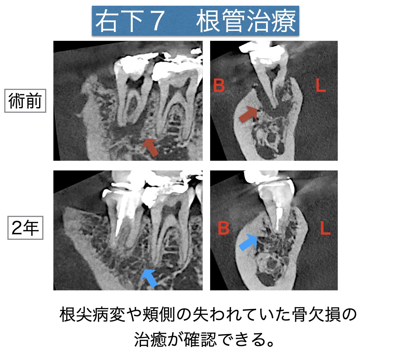 根の先の病気が原因で、歯茎が腫れてグラグラしている。抜歯したくない