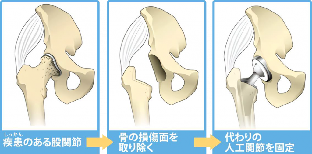 人工関節手術 | もりえい病院
