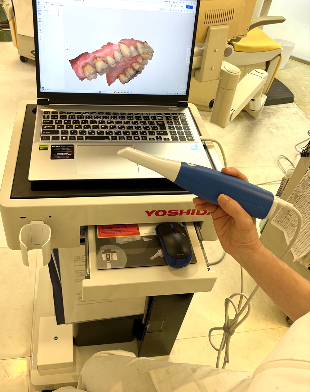 口腔内スキャナーMedit i600導入で型取りの際の不快感を解消