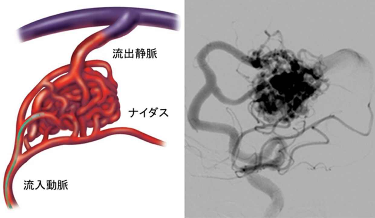 脳動静脈奇形 (AVM) | 脳神経外科 京都大学医学部附属病院