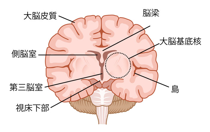 大脳基底核変性症の症状とは？パーキンソン病との違いも解説|脳梗塞