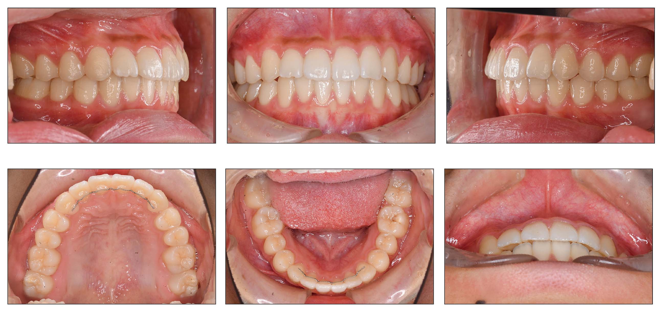 マウスピース型装置の矯正 | 刈谷の矯正歯科専門【NICO矯正歯科】刈谷