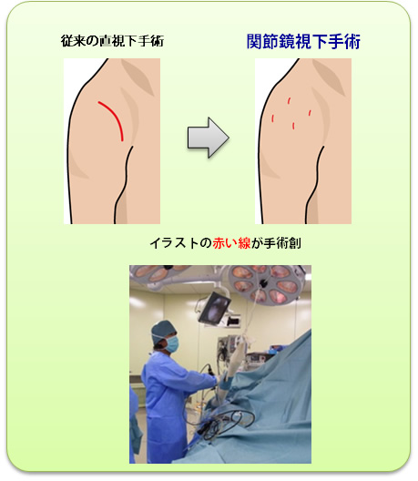 肩関節の治療 | 治療方針・診療科目 | 西村整形外科