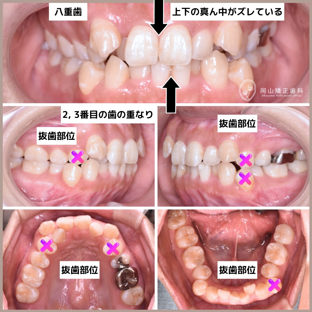 メル20723】アライナー矯正歯科治療 アライナー矯正歯科治療 | Sandra