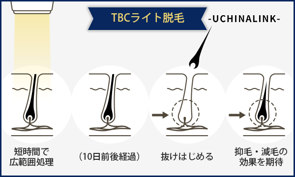 メンズTBCの評判口コミ・レビュー！ヒゲ脱毛の効果やスーパー脱毛の