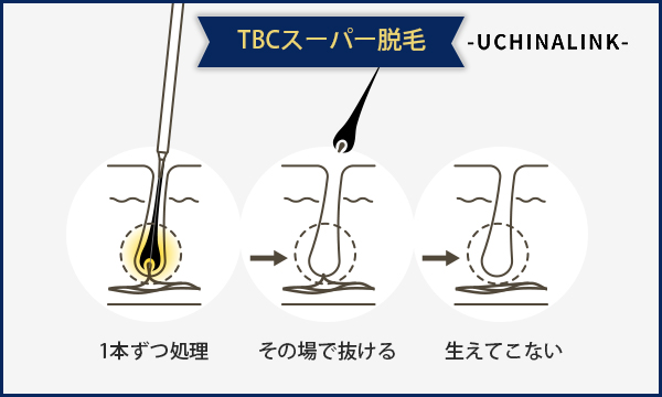 MEN'S TBC スーパー脱毛 3点セット メンズTBCクリニックの口コミや評判