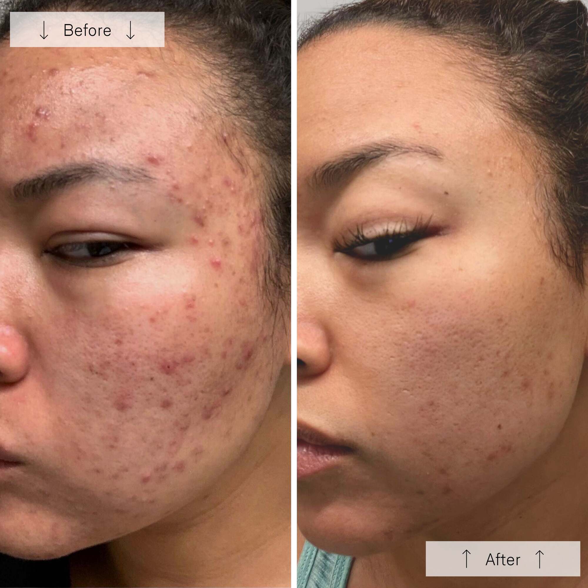 Omnilux Clear | Blue + Red LED Device for Acne