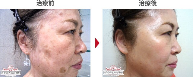 シミ取りレーザーのダウンタイムを詳しく解説！ | 表参道美容皮膚科