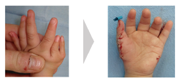 小児先天異常 - 福島県立医科大学 整形外科学講座