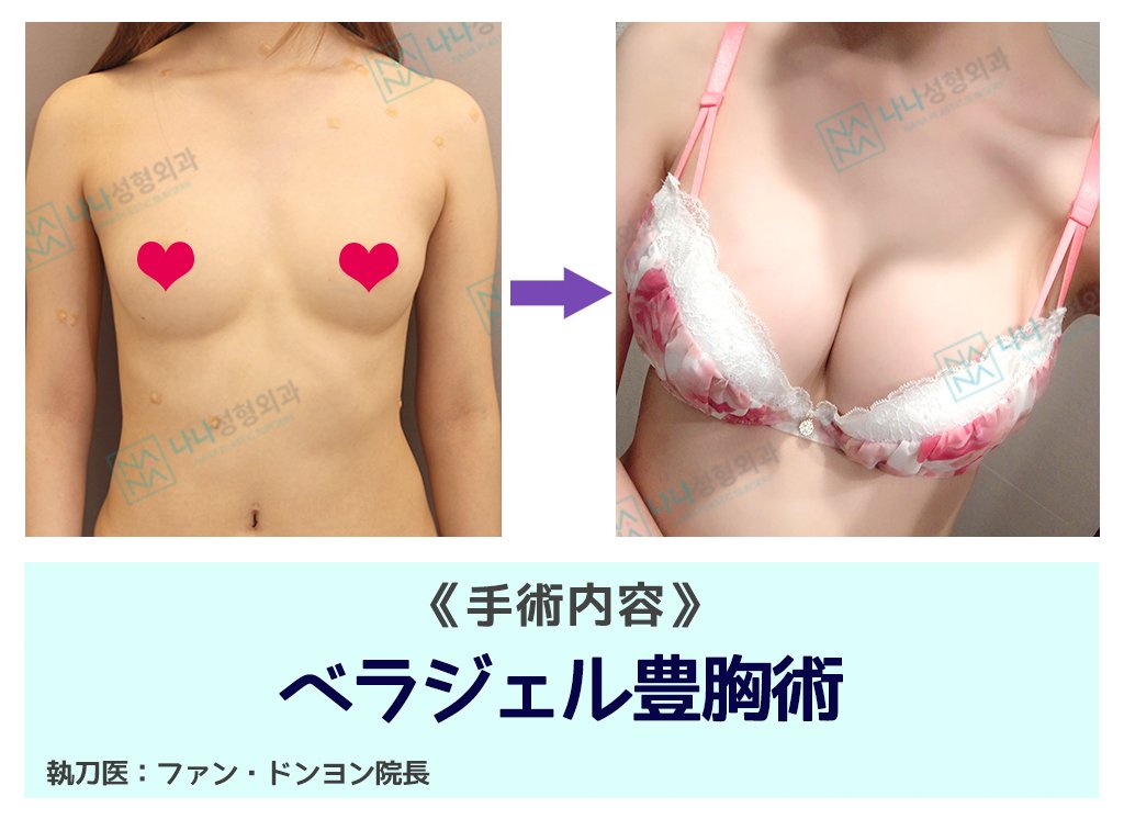 ✓NANAベラジェル豊胸術 胸についてお悩みの方❣❣ ファン院長は
